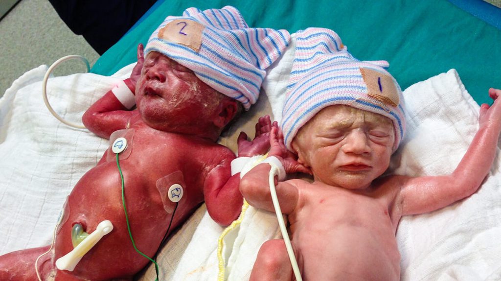 parto de gêmeos prematuro