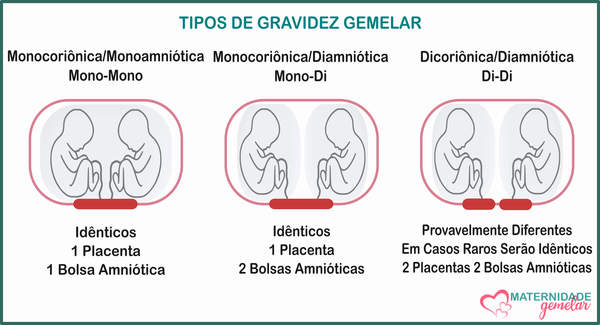 quais sao os tipos de gravidez gemelar